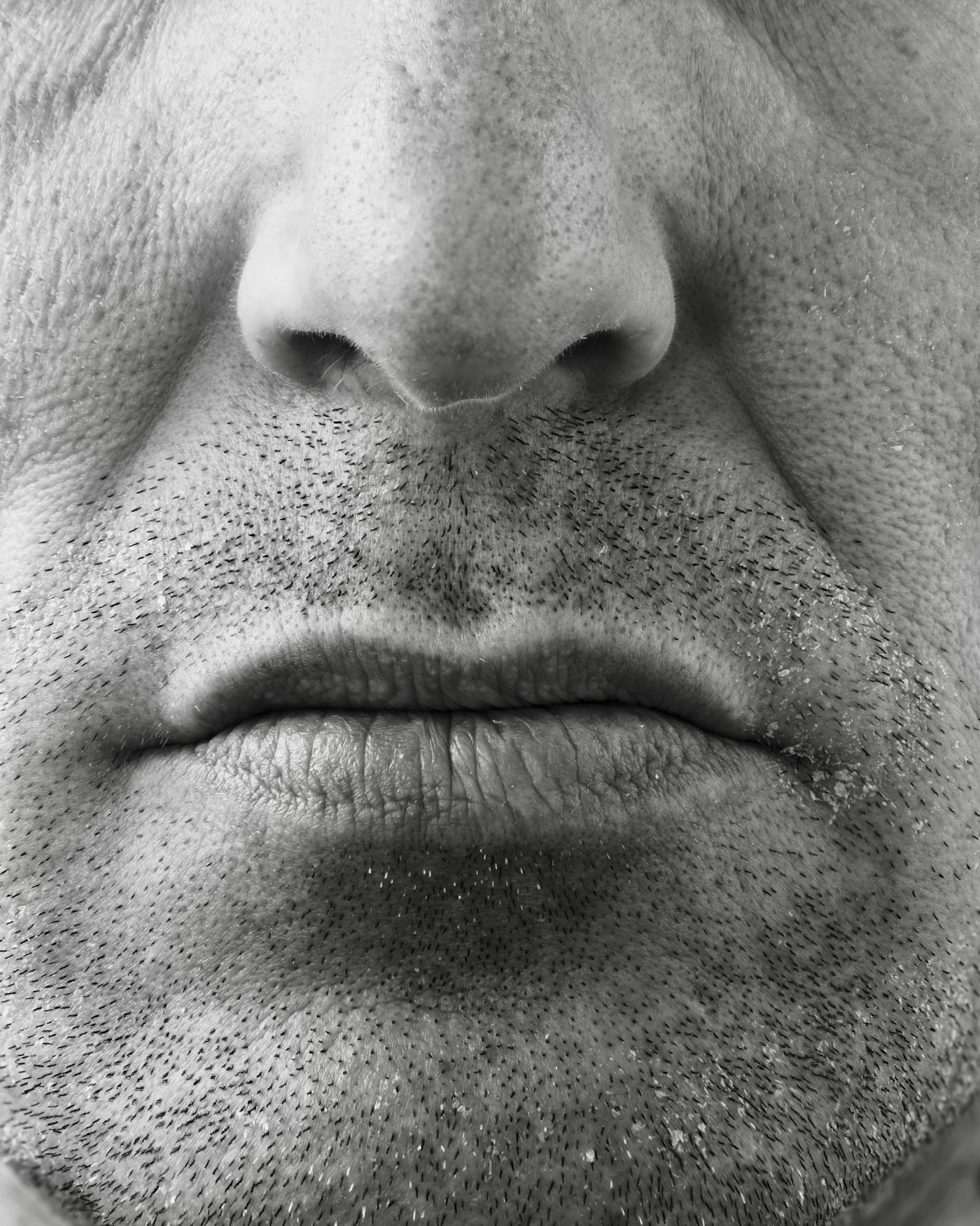 HIFU skin tightening