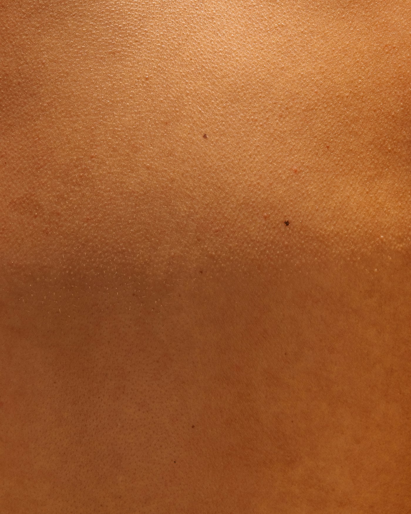 Microneedling