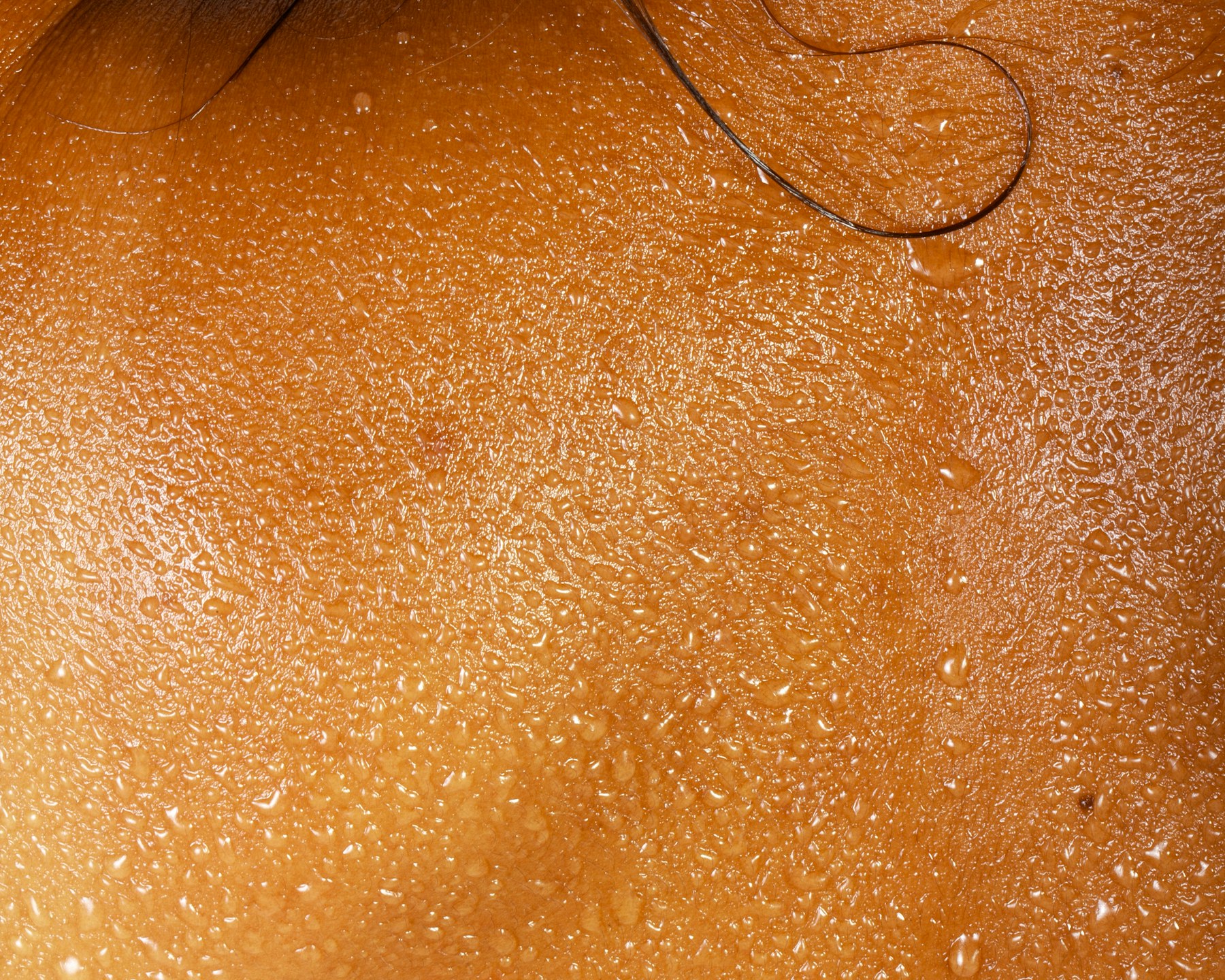 Mesotherapy