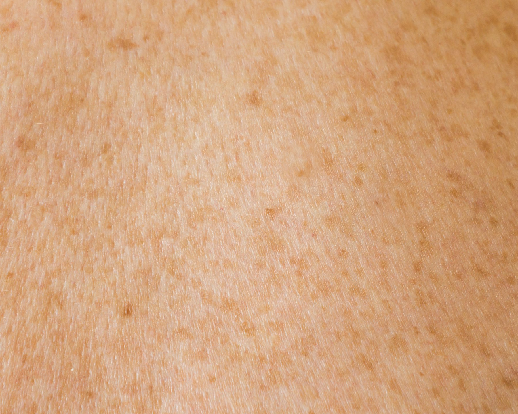 Microneedling